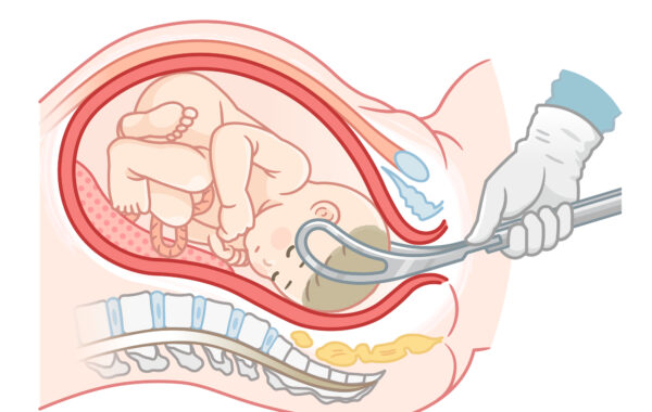 器械分娩とは